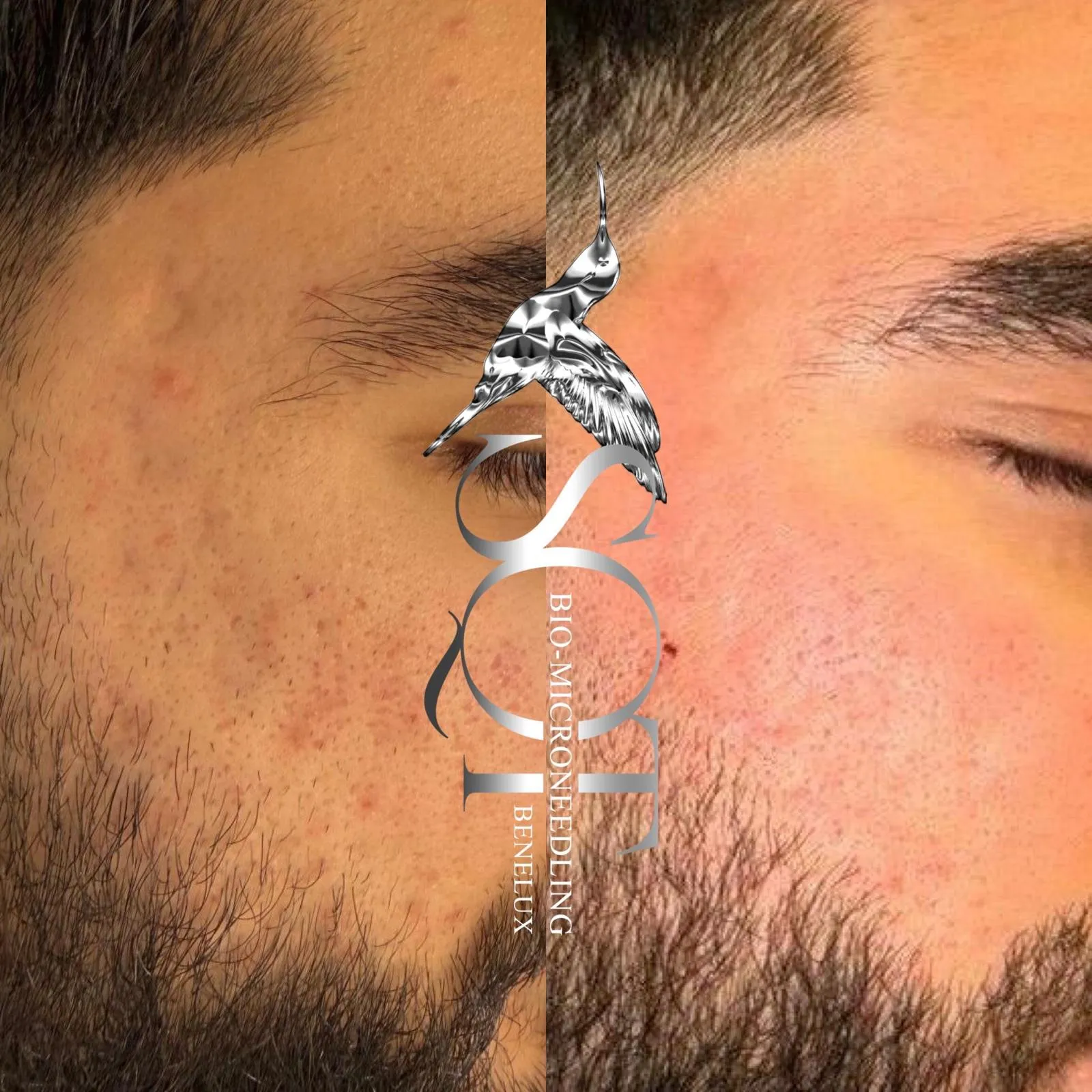 SQT Biomicroneedling öncesi ve sonrası: solda akne ve pürüzlü cilt, sağda aynı cilt bakımdan sonra, hâlâ biraz kırmızı